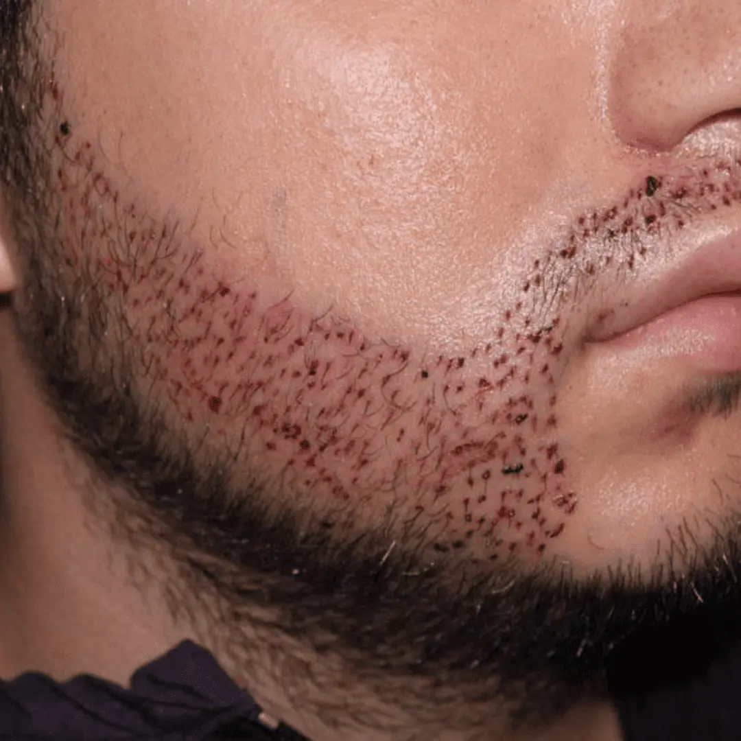 What Is Mustache Hair Transplant and How Does It Work?