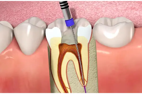 Root Canal Therapy