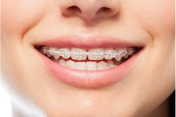 Orthodontics Treatments