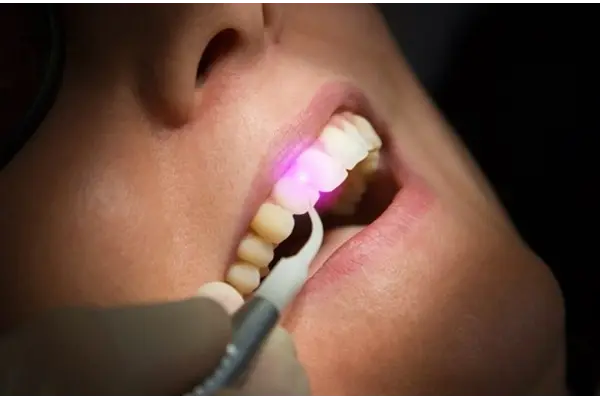 Laser Dentistry Treatments