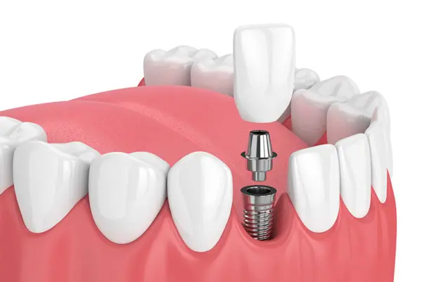 Missing Teeth Replacement