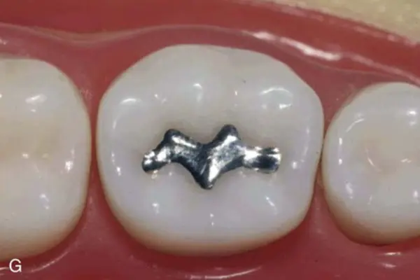 Restoration of Teeth Treatments