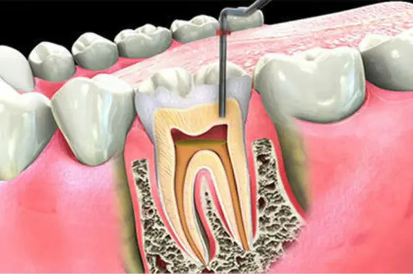 Root Canal Treatment