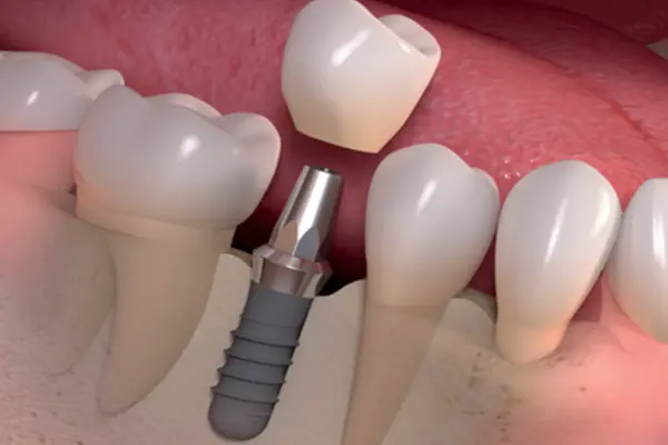 Dental Implants Treatments