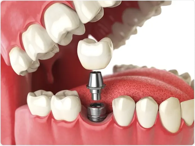 Missing teeth replacement