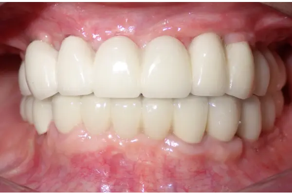 Full Mouth Rehabilitation