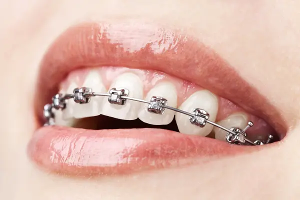Orthodontic Treatments
