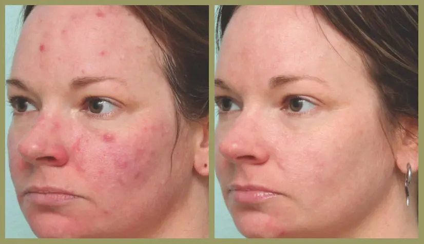 Sun Tan Removal