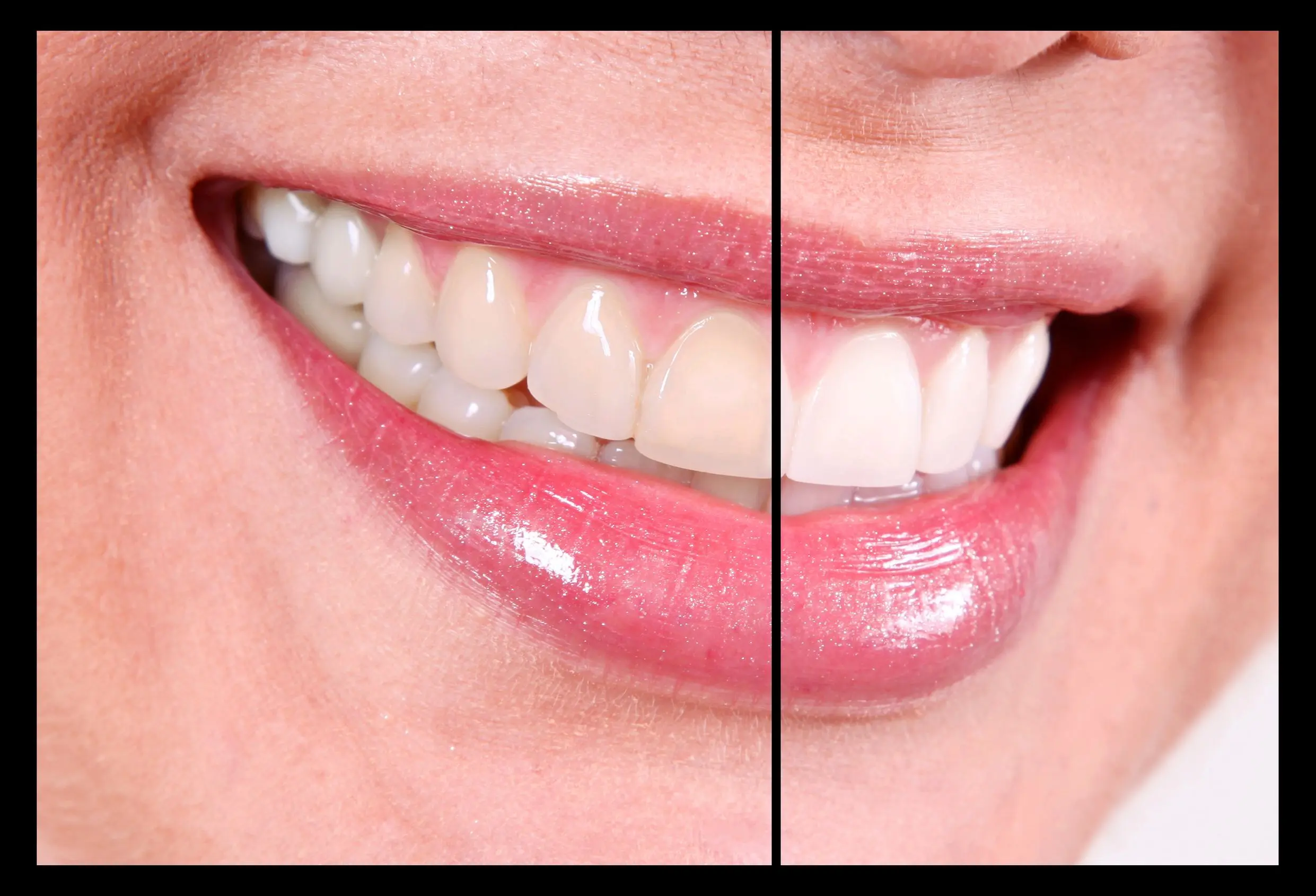 Teeth Whitening 