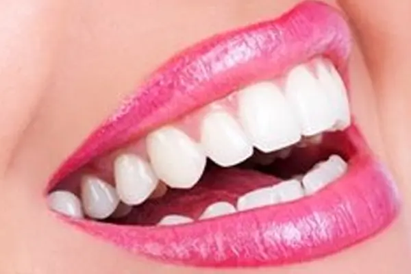 Teeth Whitening