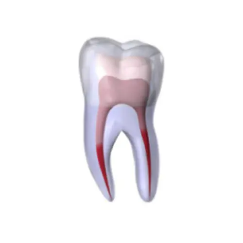 Root canal Treatment