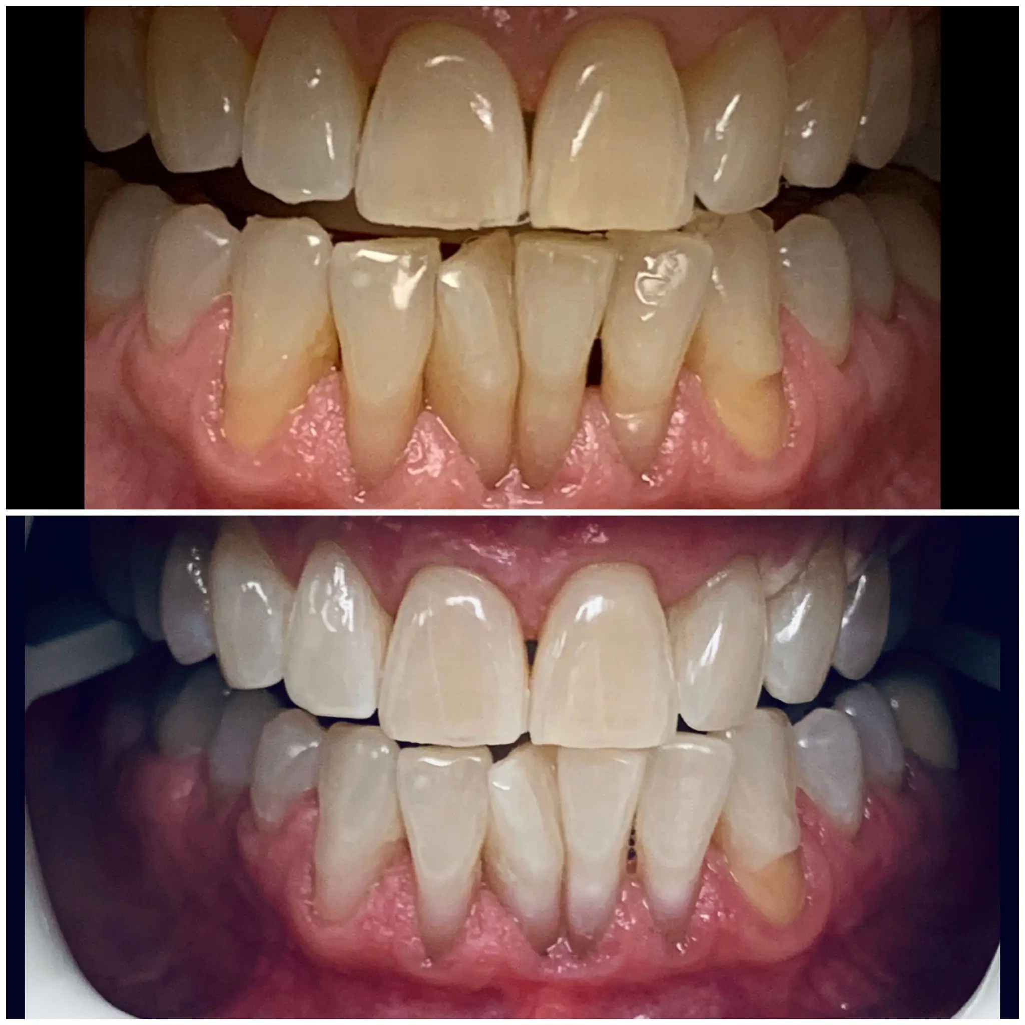 Root canal treatment