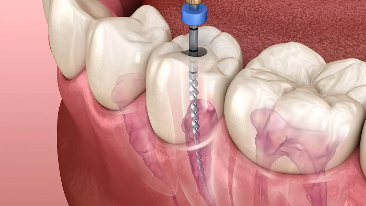 Root canal Treatment