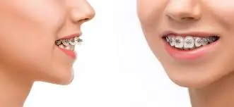 Orthodontic Treatment