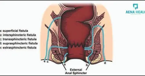 Treatment for Fistula