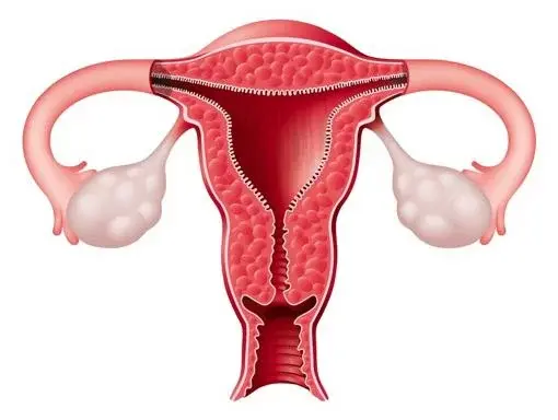 Endometriosis