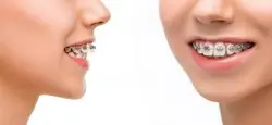 Orthodontic Treatment