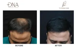  Hair Transplant 