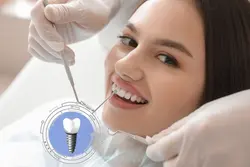 Dental Implants
