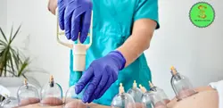 Cupping Therapy