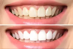  Teeth whitening