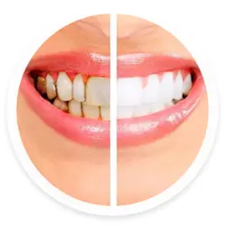 Teeth Whitening