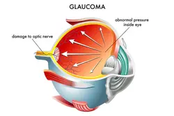 Glaucoma