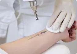 Tattoo Removal