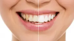 Teeth Whitening