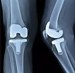Knee Replacement