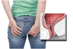 Piles Treatment