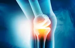 Total Knee Replacement