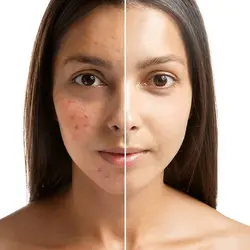 Acne Scar