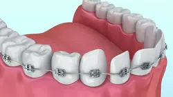 Alignment Teeth Treatment