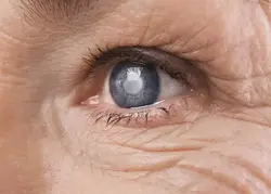 Glaucoma Treatment