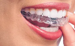 Invisalign