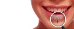 Dental Implant