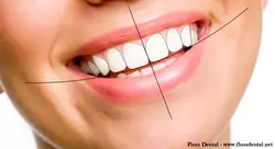 Smile Designing