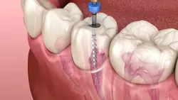 Root canal Treatment