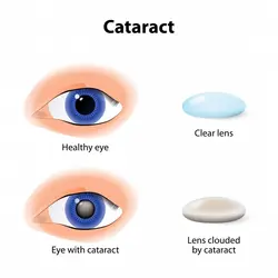 Cataract Surgery
