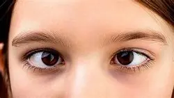 Pediatric Squint Treatment & Surgery