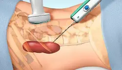 Kidney Biopsy