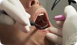 Root Canal