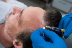 Direct Hair Transplant (DHT)