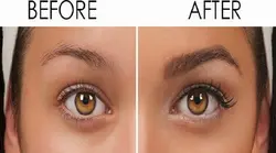 Eyebrow Hair Transplant