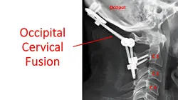 C1-C2 Fusion Surgery 
