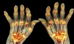 Arthritis Care