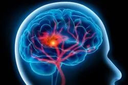 Stroke