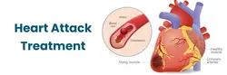 Heart Attack Treatment
