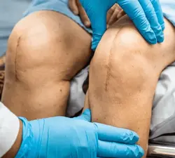 Knee Replacement Surgery